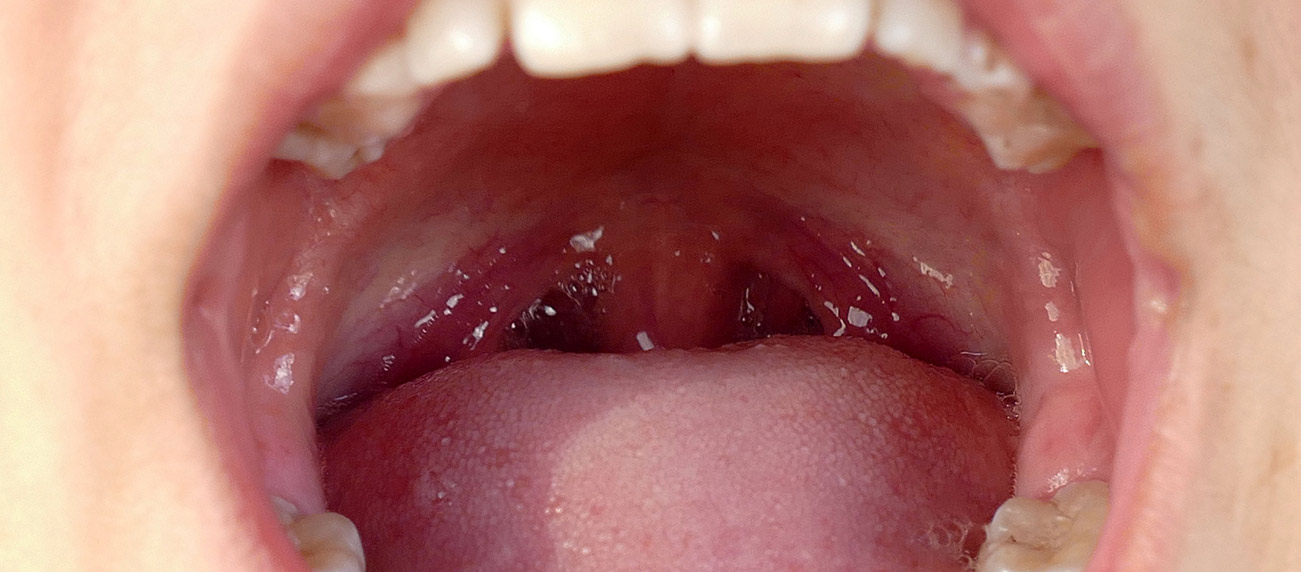 What Are Tonsil Stones and What Do I Do About Them Article Image