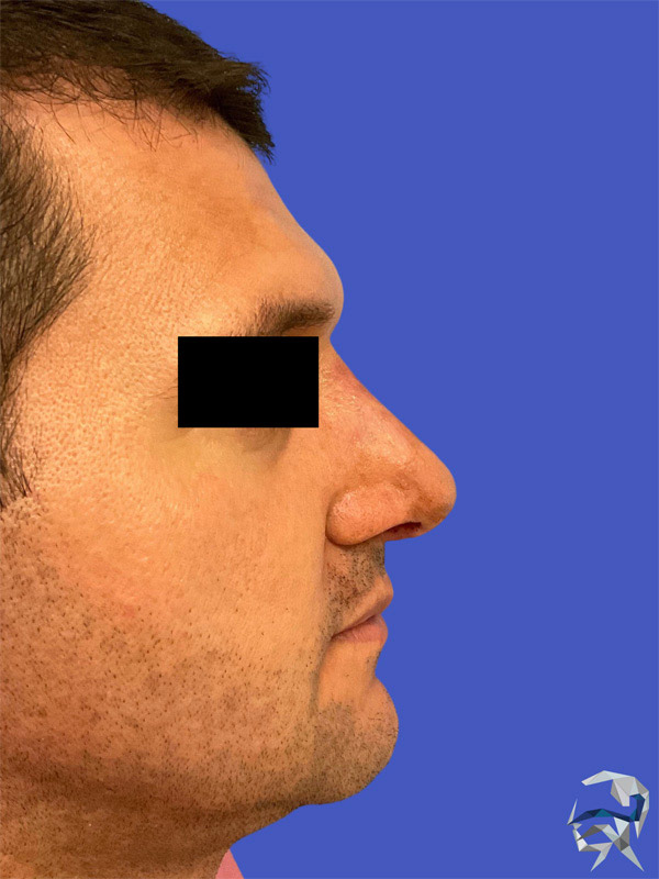 Dr. Brian Rotenberg Rhinoplasty male sample image