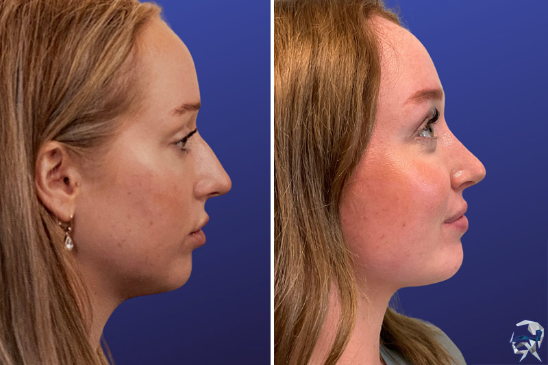 Rhinoplasty before and after female