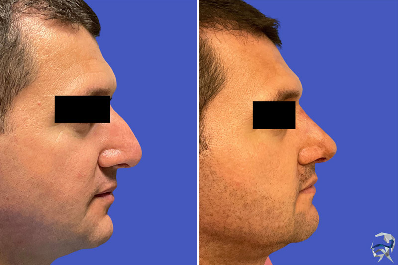 Rhinoplasty before and after male