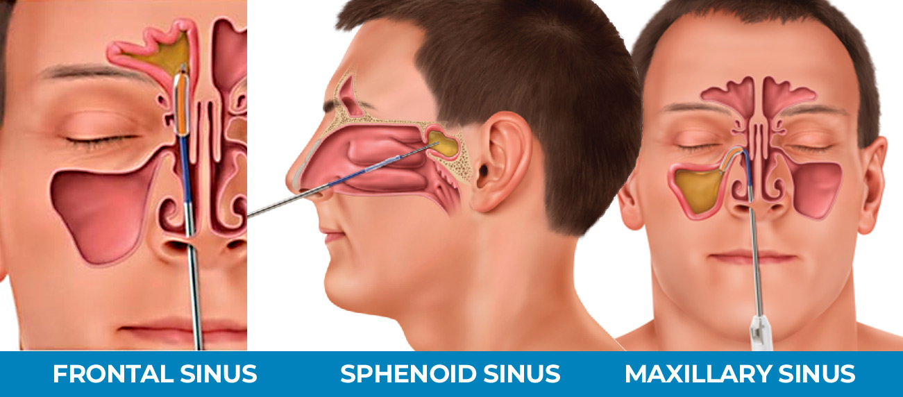 What is Balloon Sinuplasty?
