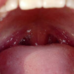 What Are Tonsil Stones and What Do I Do About Them?